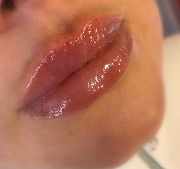Увеличение губ в Мытищи фото 5