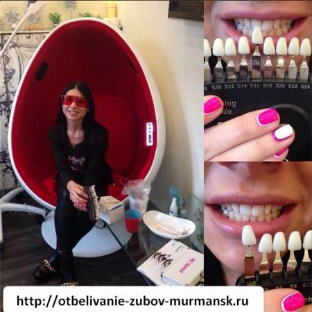 Салон косметического отбеливания зубов в Мурманске фото 4