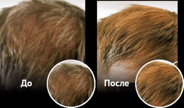 Спрей для восстановления и роста волос Ultra Hair Spray Syst в Москве фото 6